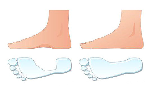 C0072003 Flat foot comparison 482